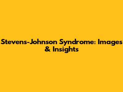 Stevens-Johnson Syndrome: Images & Insights